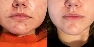 apl1a professional ipl hair removal & skin rejuvenation system