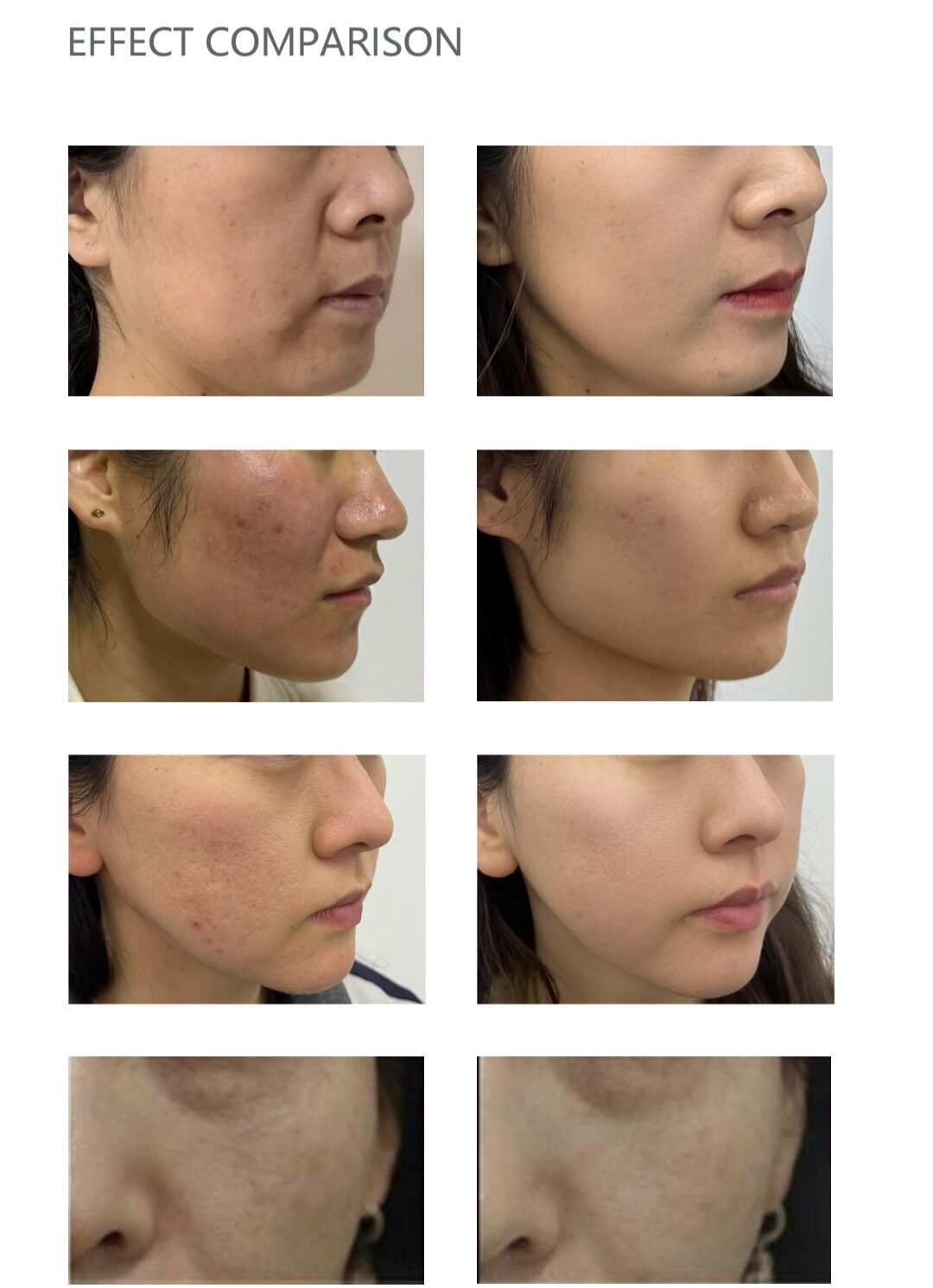 1927nm fractional thulium laser – premium non ablative skin resurfacing & pigmentation correction system