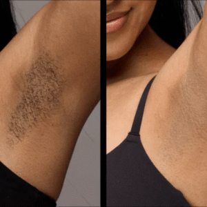 Laser Hair Removal Equipment