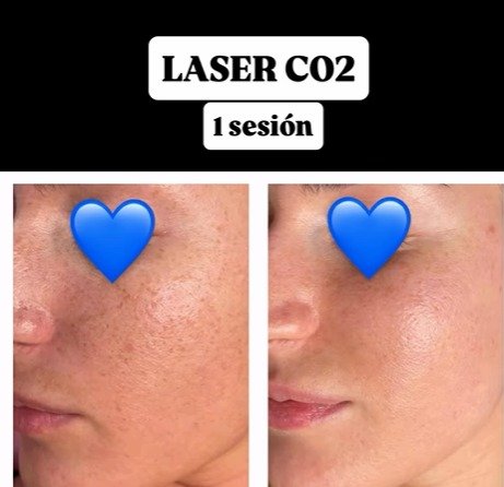 digital co₂ fractional laser machine – model l300 | 3 in 1 facial, gynecological & surgical treatments