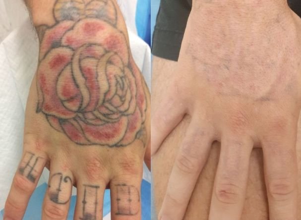 Pico laser tattoo removal results