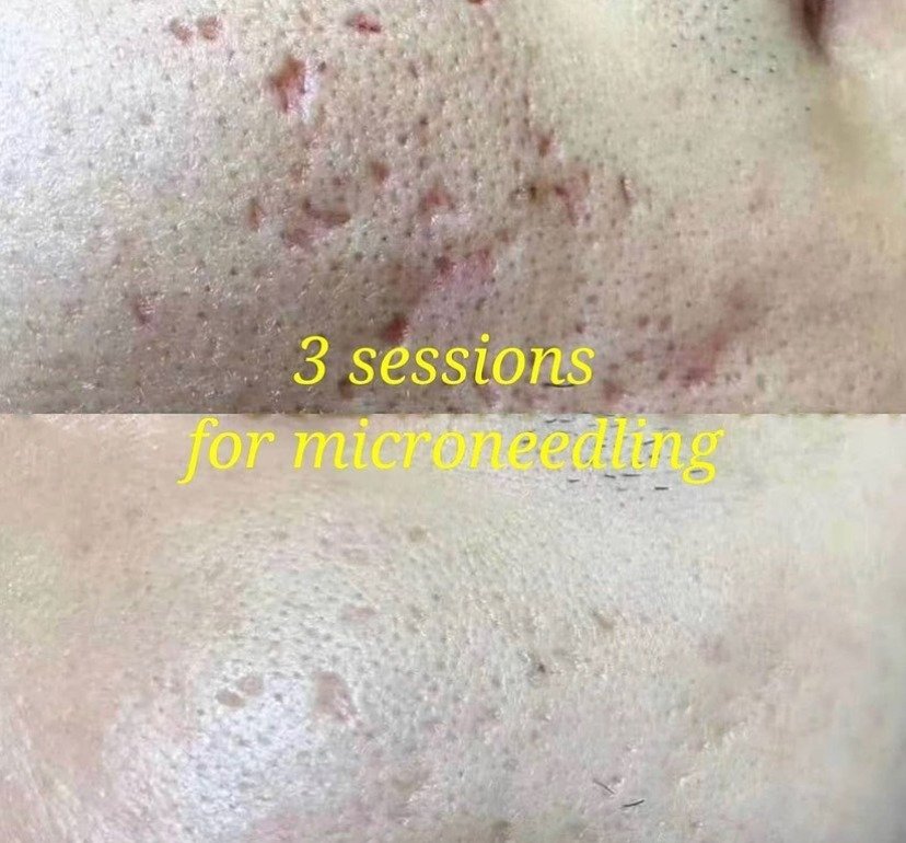 microneedling rf before and after