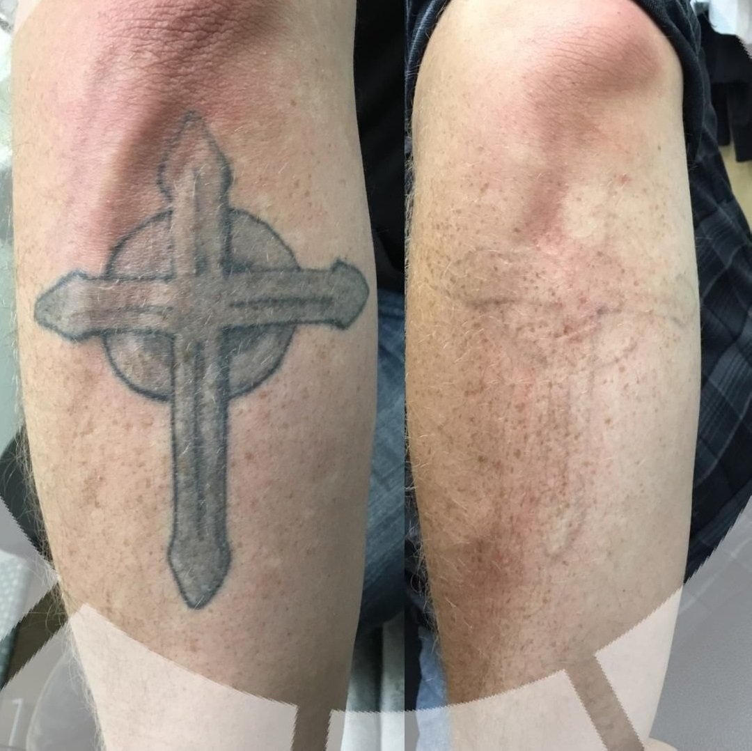 picosecond nd:yag laser tattoo removal machine | medical ce certified