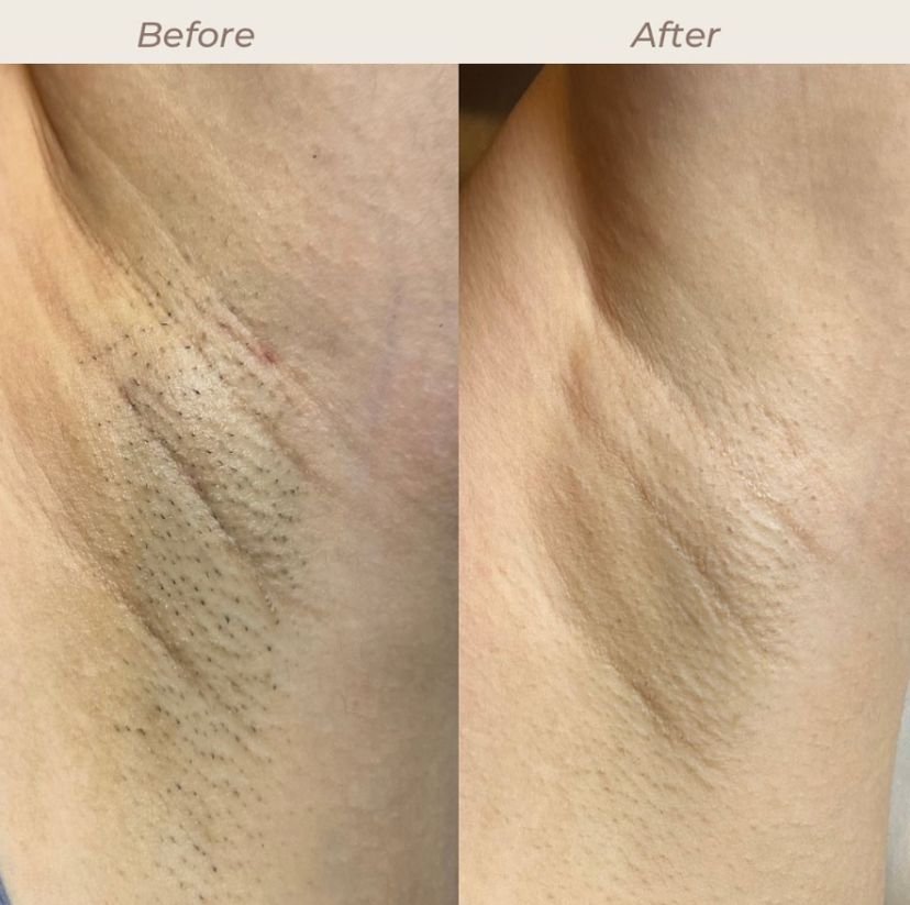 808nm diode laser hair removal treatment before and after results