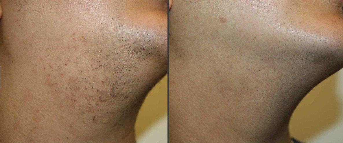 t5pro portable diode laser hair removal machine1200w