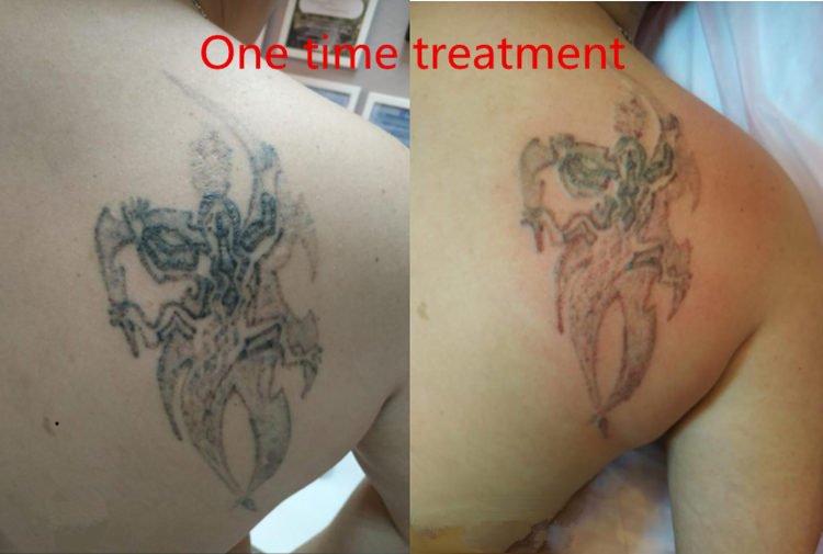 3 in 1 pico laser + 808nm diode laser + rf microneedling system