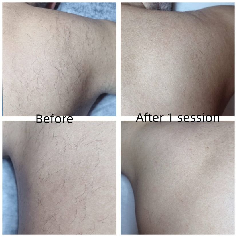 Before and after 1 session diode laser hair removal treatment
