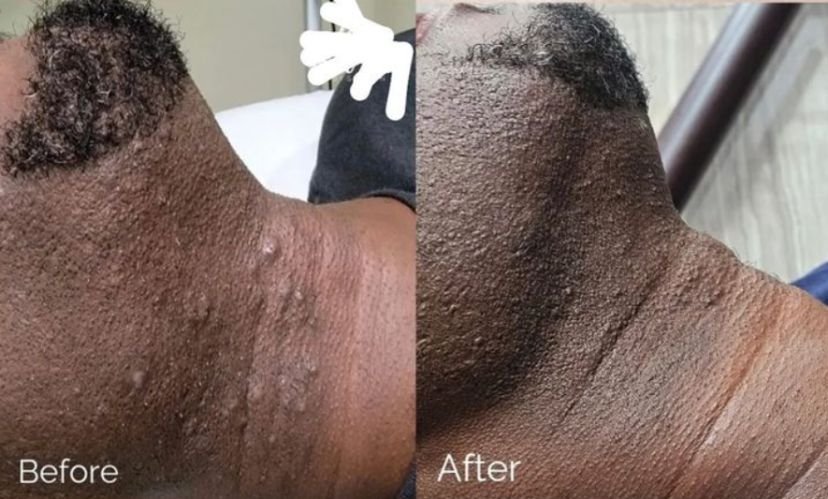 Before and after dark skin man beard permanent hair removal with diode Laser Hair Removal Machine 