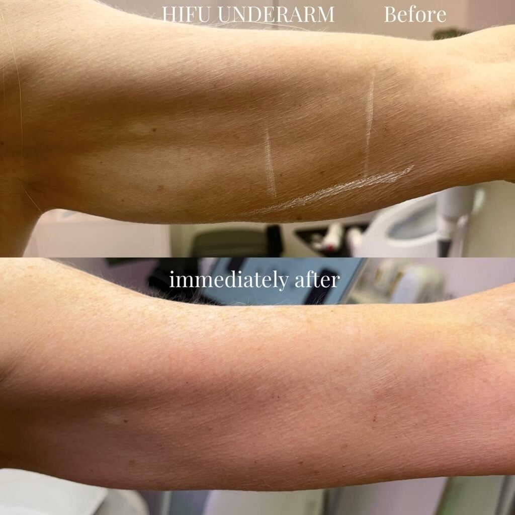 Hifu treatment results