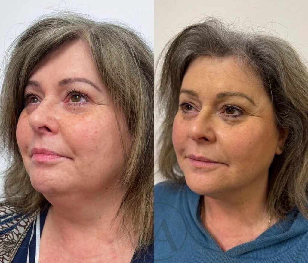 Before and after full face lift with 3 in 1 hifu