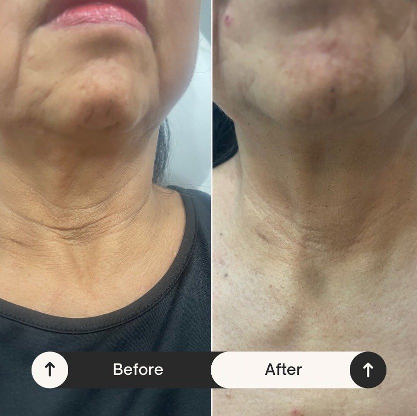 3 in 1 pico laser + 808nm diode laser + rf microneedling system