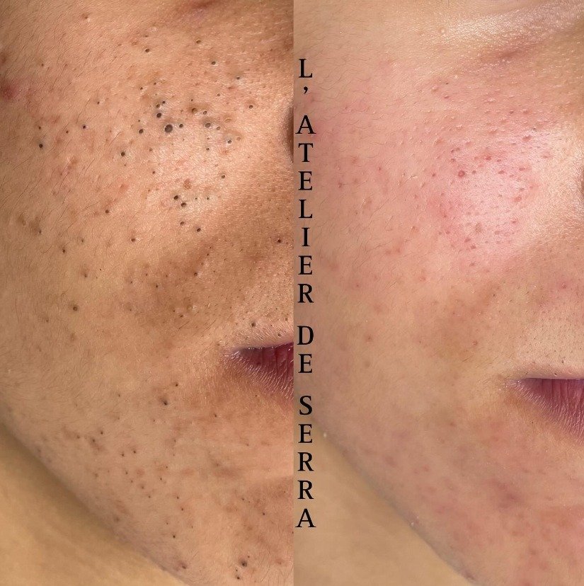 Microneedling RF before and after skin tightening, acne clearance and stretchmarks reduction