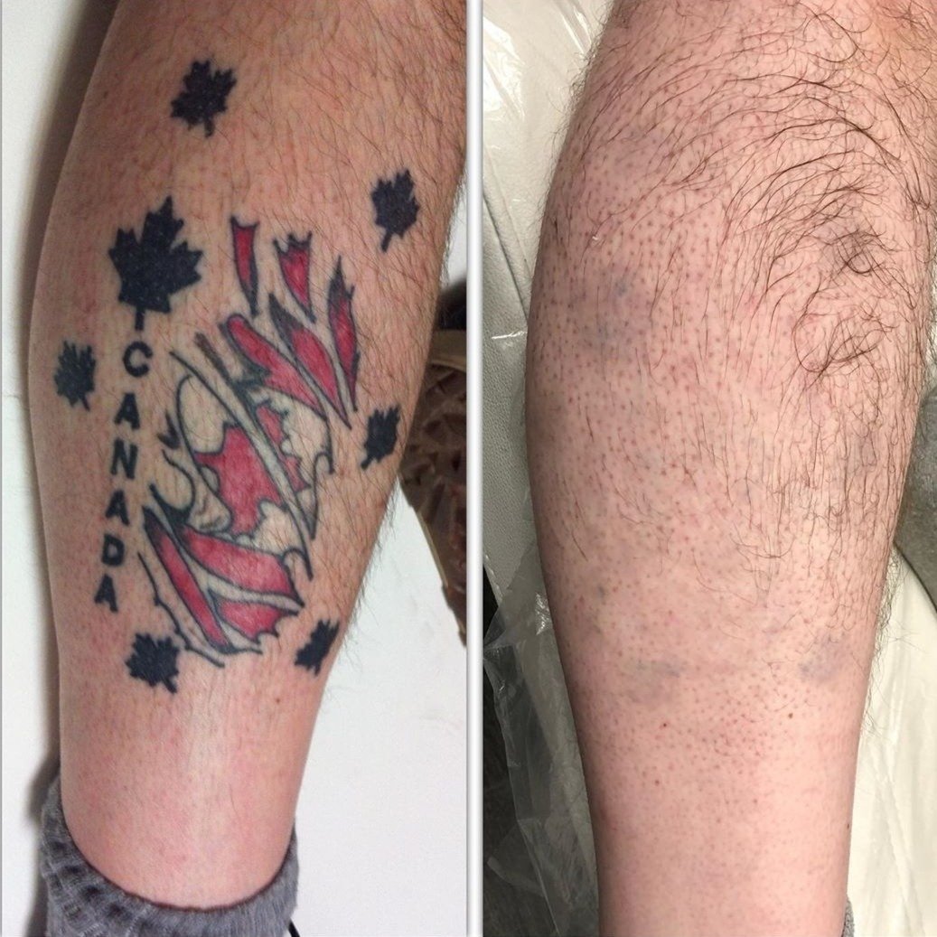 picosecond nd:yag laser tattoo removal machine | medical ce certified