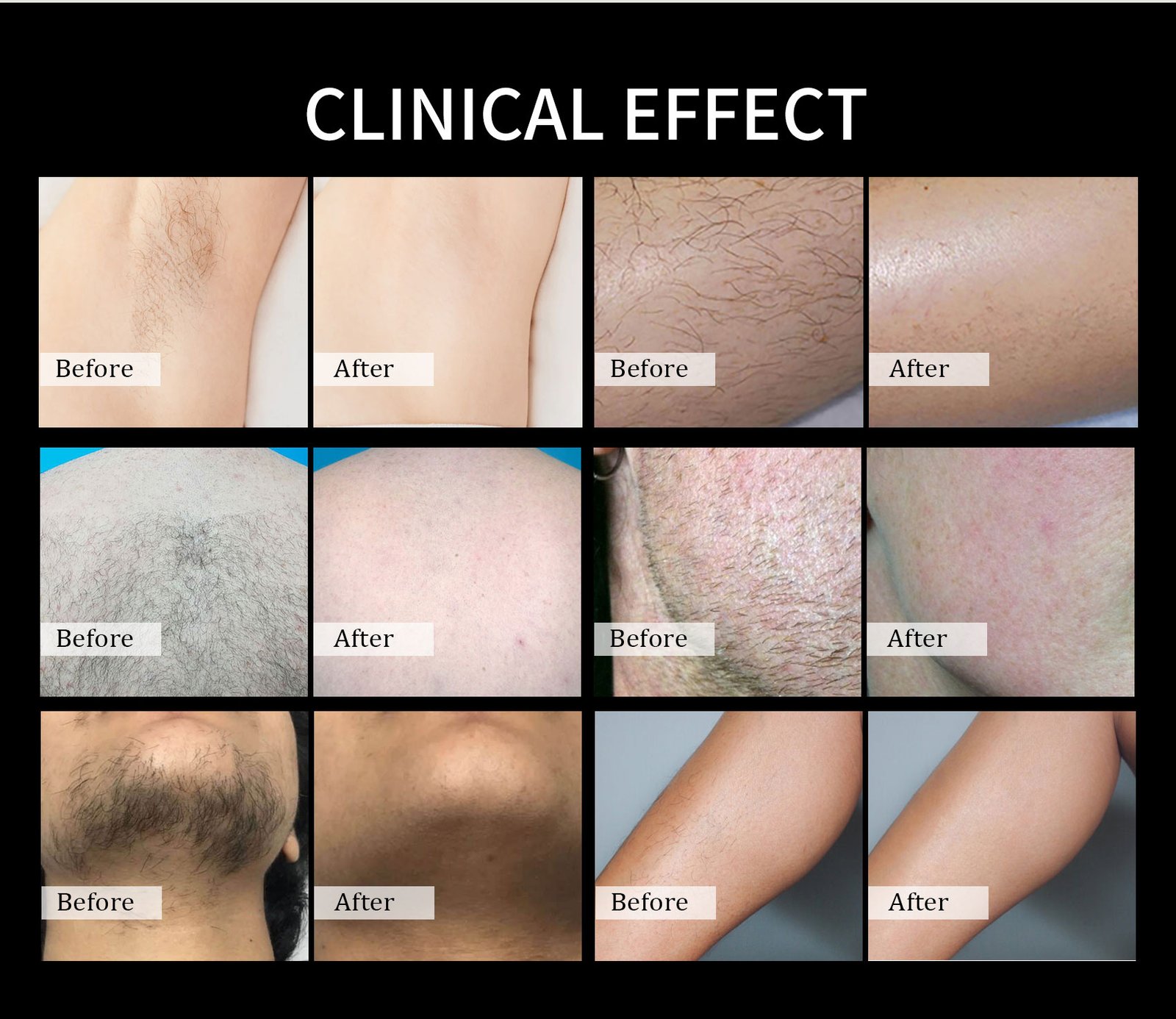 diode laser before and after hair removal results