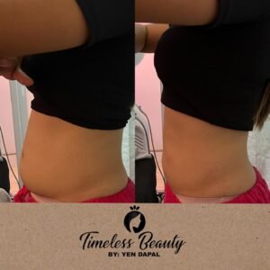 Hifu body contouring machine