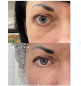 hifu facelift results