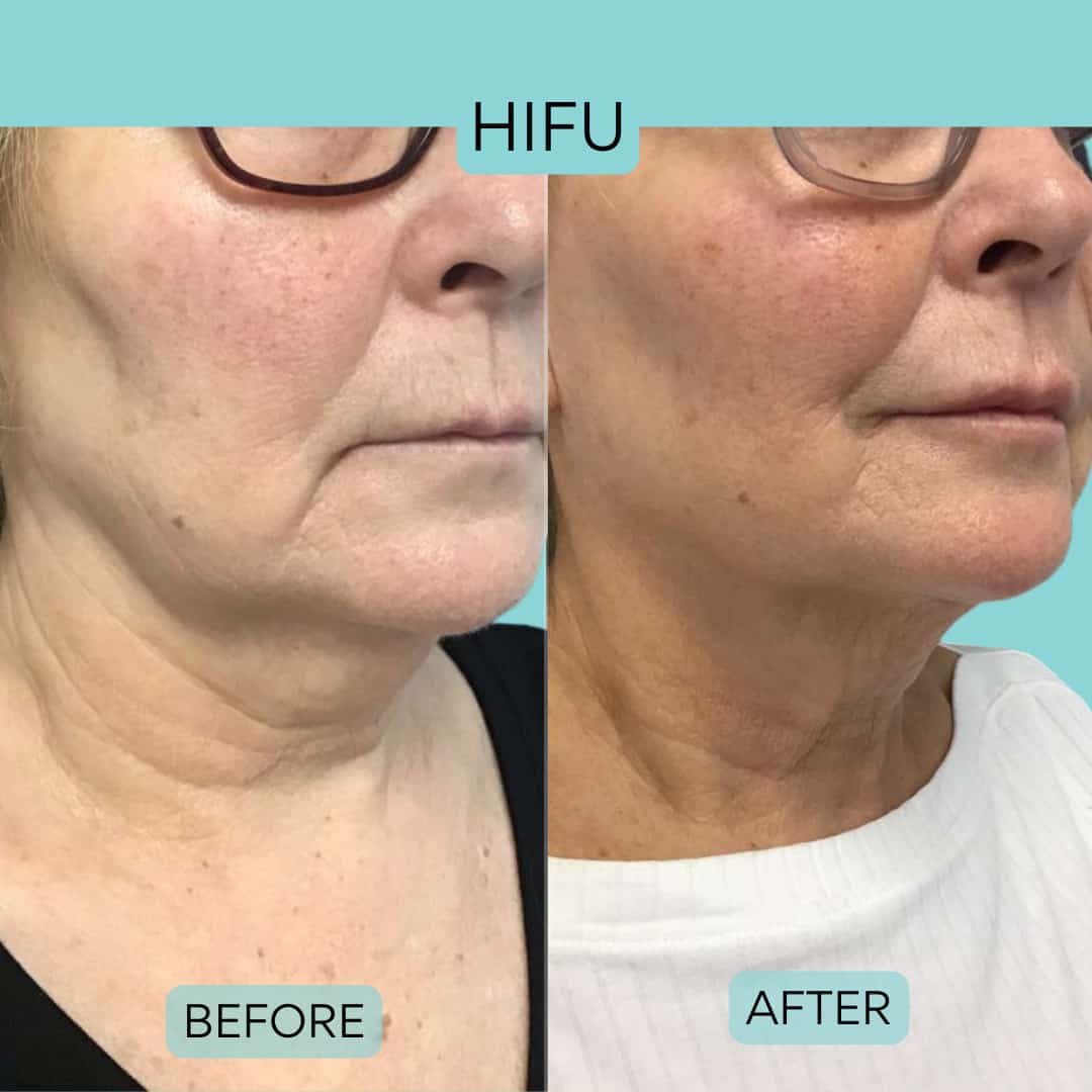Sinako DermaLift Pro™ Professional HIFU Machine - Image 8