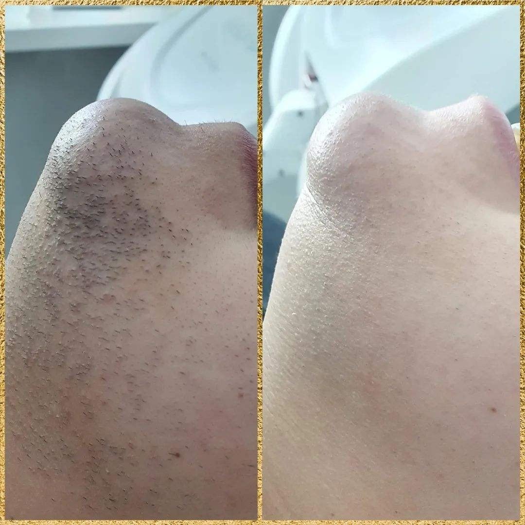 beard laser hair removal machine