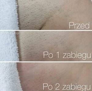 permanent laser hair removal machine results