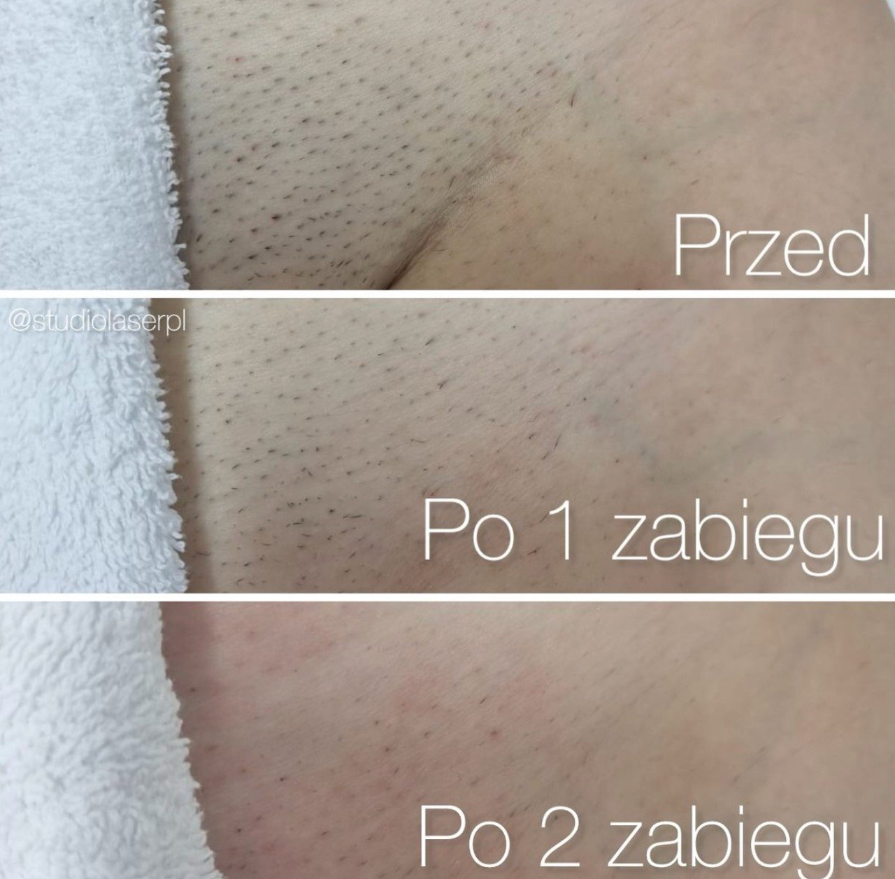 permanent laser hair removal machine results