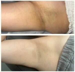 Before and after laser hair removal treatment