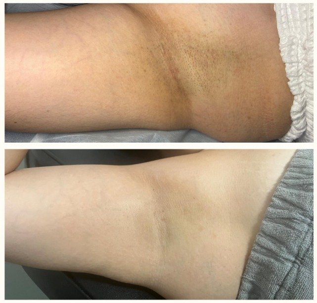 Before and after laser hair removal treatment