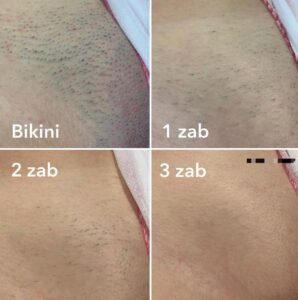 bikini laser hair removal results