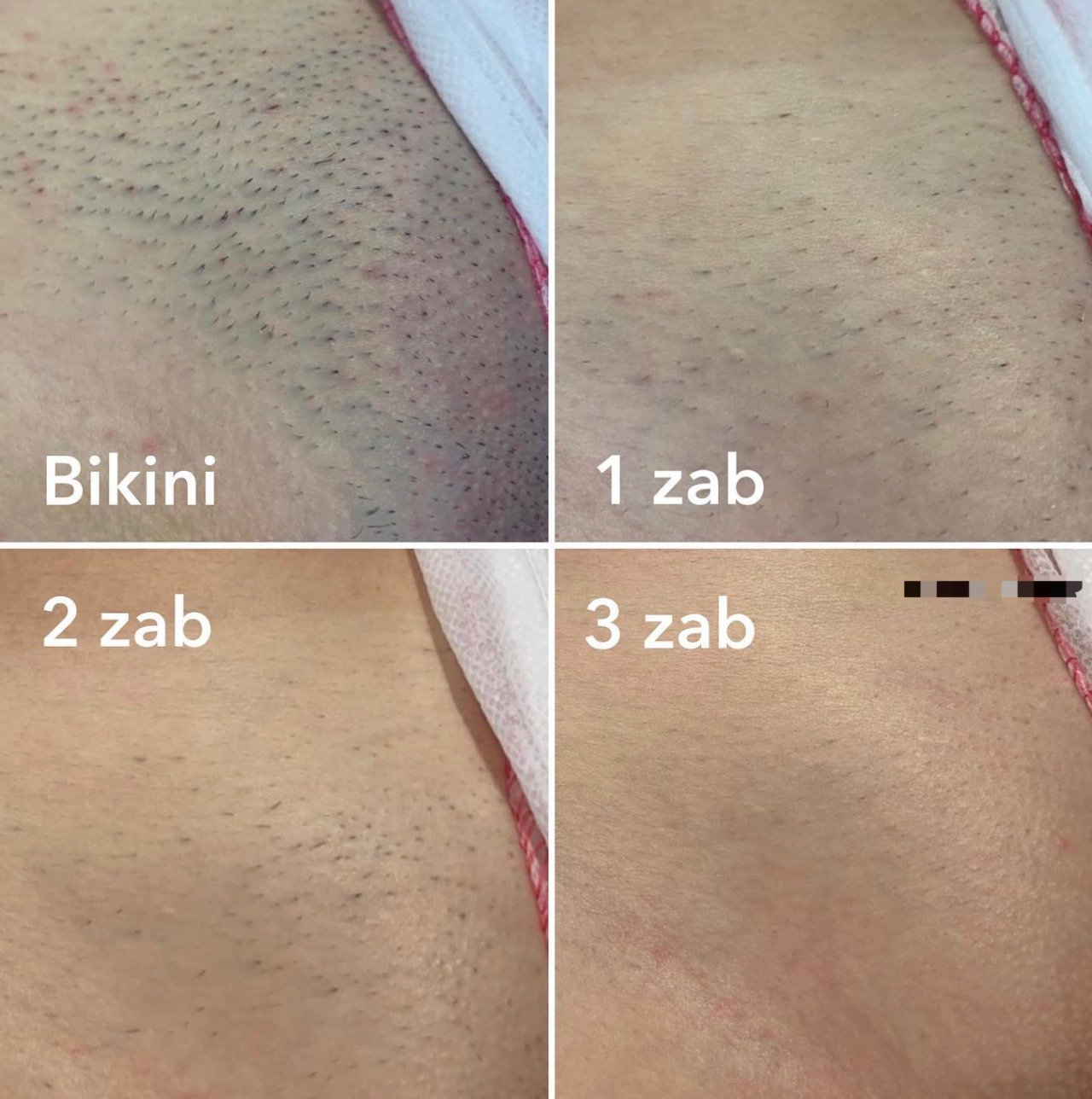 bikini laser hair removal results