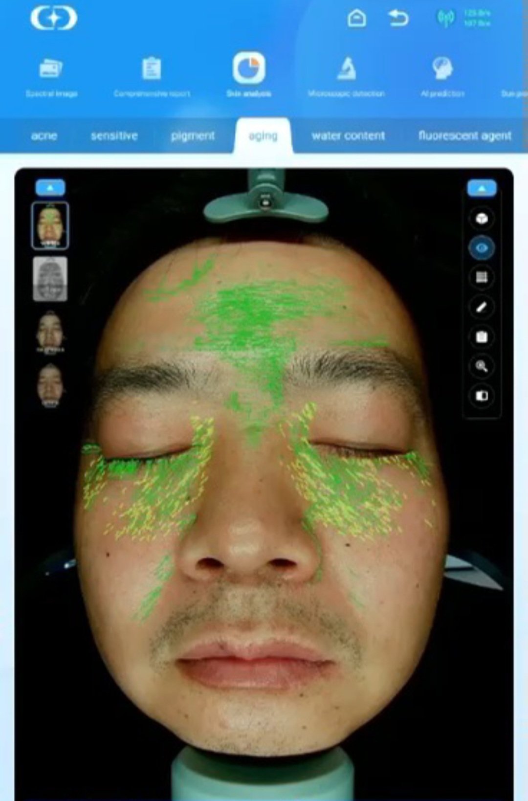 Advanced AI skin analyzer machine for derma clinic