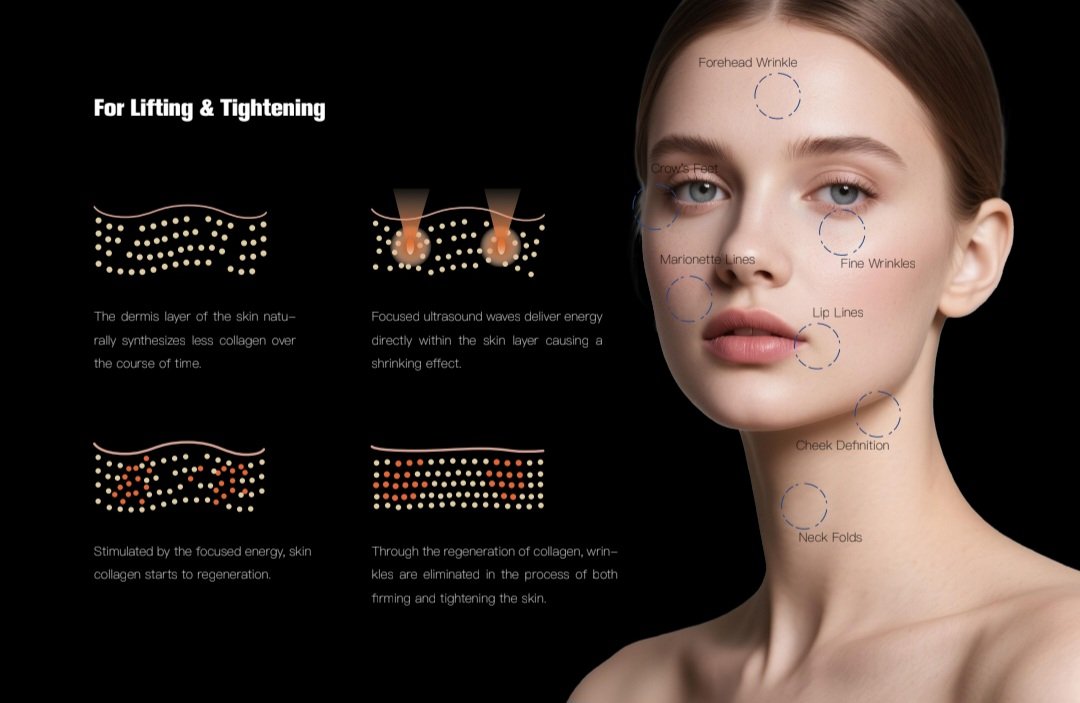 Hifu facelift machine Pro South Africa
