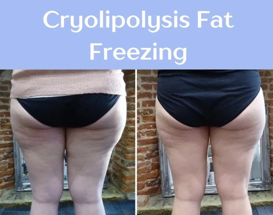 Cryolipolysis Machine | Cryo TEC Pro – Sinako Medical - Image 5