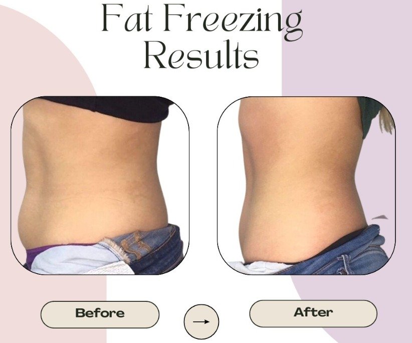 Cryolipolysis Machine | Cryo TEC Pro – Sinako Medical - Image 6